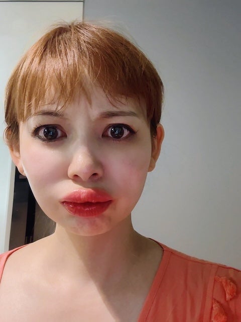 中川翔子、くちびるが５倍に？！「早く病院に行って！」と心配の声