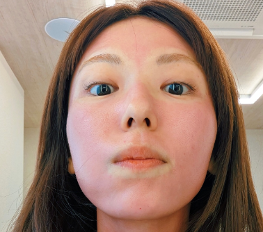 顔が真っ赤！？若槻千夏、レーザー施術後の姿を公開