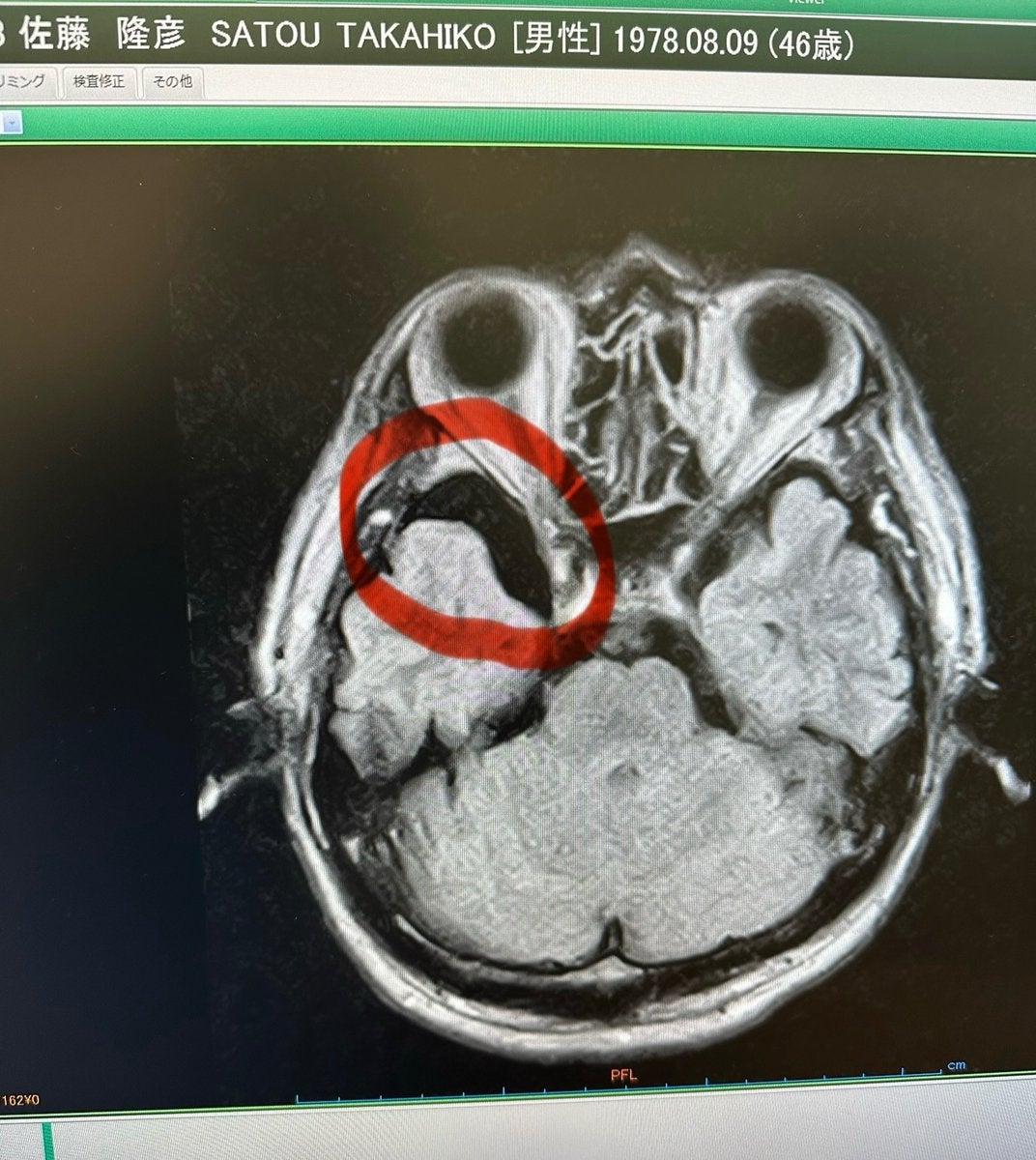 「何に影響が出るか教えて欲しい」GG佐藤が脳ドッグで言われた驚きの言葉とは