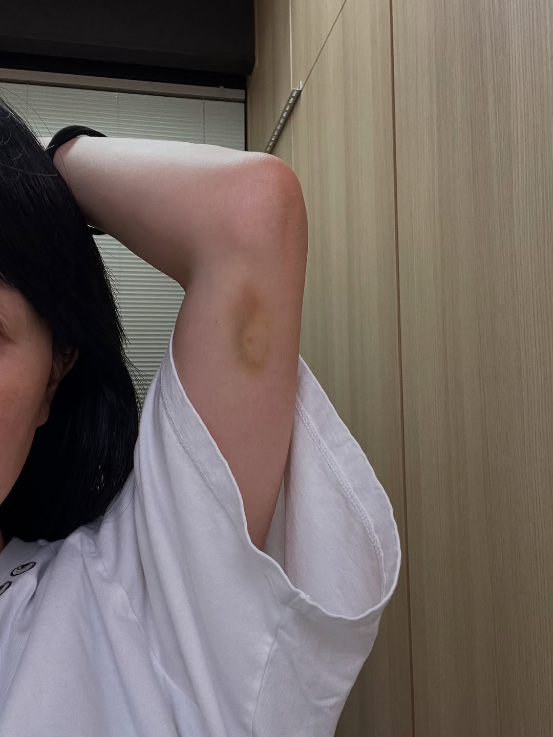 「軽く当たっただけなのに...」東尾理子、アザの原因に驚愕