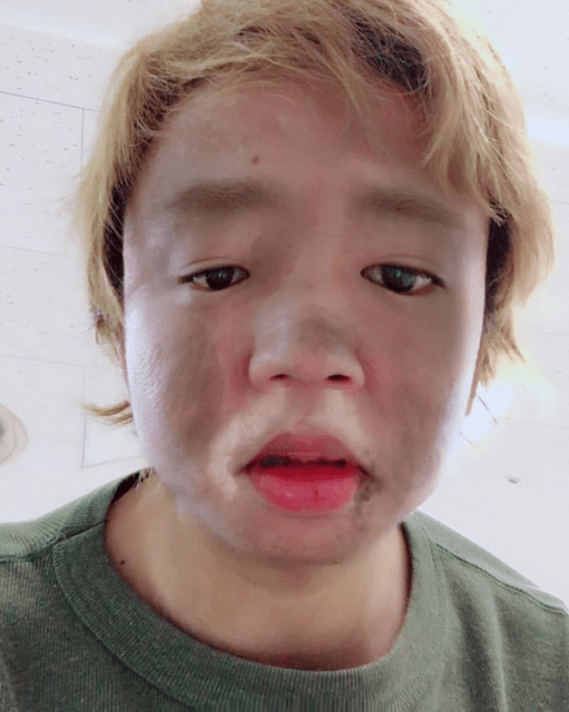 「閲覧注意⁉」楽しんご火傷の真相は…？