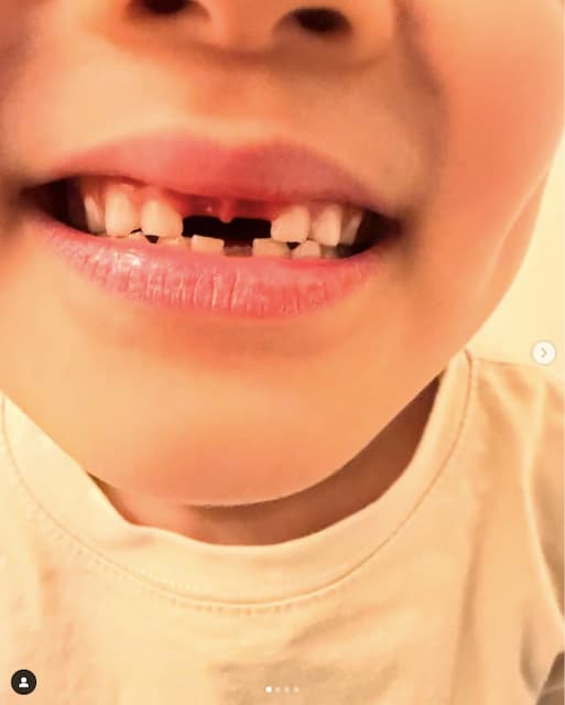 山内健司、「痛々しい」歯の抜け方に息子が号泣したことを報告