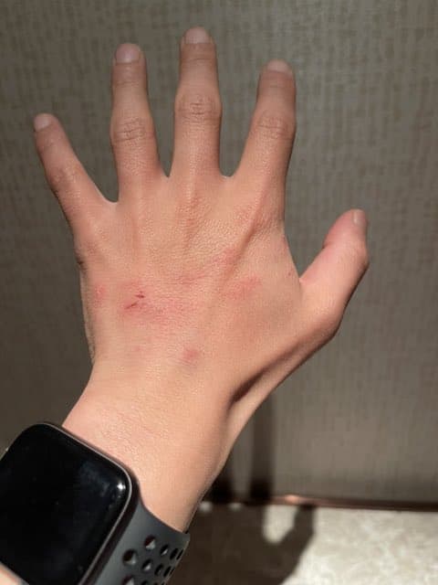 嵐・二宮和也が傷だらけに😰「しょうがない」