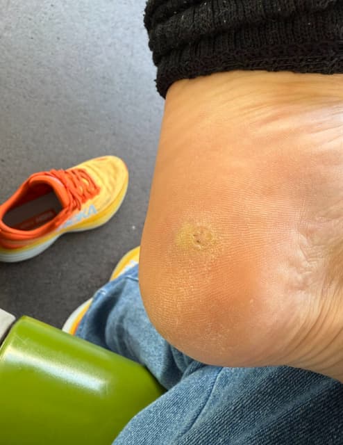 鈴木Q太郎、足裏にできたイボに「痛み押し切ってネタしてるぜ」と感心されたいと願う