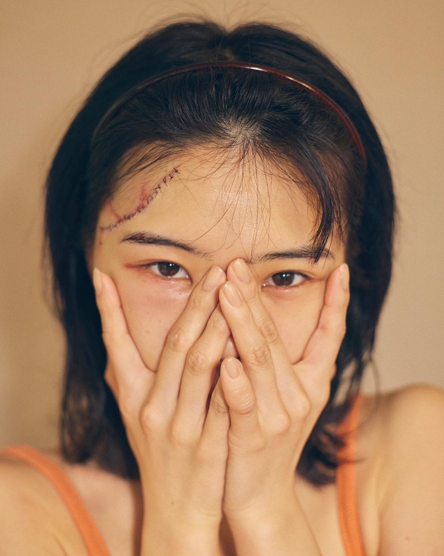 アイナ・ジ・エンド、合計30針縫う大怪我😭衝撃写真を公開「死にたくない」