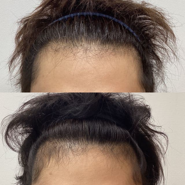 「ありがとうハゲ病院。」ダブルヒガシ大東翔生、頭髪の復活に感激！半年前との違いに驚きの投稿