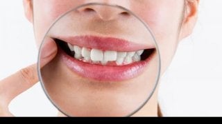 歯ぐきの黒ずみを治したい！原因と治療法を知ろう