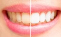 キレイになりたい！真っ白で美しい芸能人の口もとのヒミツとは？