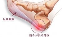 足底腱膜炎という症状をご存知ですか？