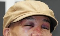 【ボクシング】WBA王座統一の堤聖也、鼻骨骨折で４時間の整形＆縫合手術「全治とか言われていない」