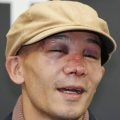 【ボクシング】WBA王座統一の堤聖也、鼻骨骨折で４時間の整形＆縫合手術「全治とか言われていない」